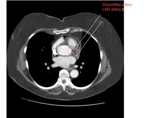 Circumflex artery (LCx)
LAD artery (LAD)
 
