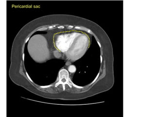 Pericardial sac
 