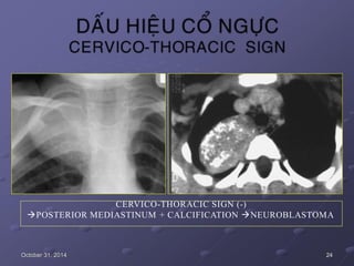 CERVICO-THORACIC SIGN (-)
POSTERIOR MEDIASTINUM + CALCIFICATION NEUROBLASTOMA
October 31, 2014 24
 