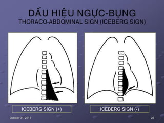 ICEBERG SIGN (+) ICEBERG SIGN (-)
October 31, 2014 25
 