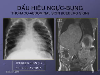 ICEBERG SIGN (+)
NEUROBLASTOMA
October 31, 2014 26
 