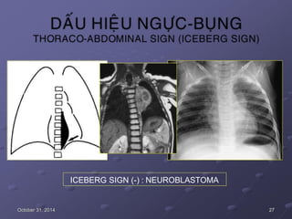 ICEBERG SIGN (-) : NEUROBLASTOMA
October 31, 2014 27
 