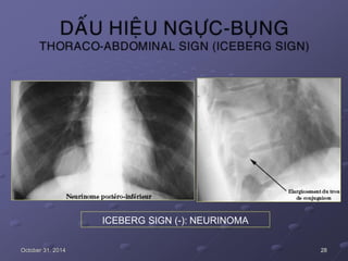 ICEBERG SIGN (-): NEURINOMA
October 31, 2014 28
 