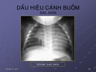 THYMIC SAIL SIGN
October 31, 2014 29
 