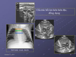 October 31, 2014 31
Caáu truùc hoài aâm luoân luoân ñaëc,
ñoàng daïng
THYMIC SAIL SIGN
 