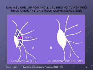 October 31, 2014 D.Anthoine et al.L’Imagerie Thoracique.1996-1998. 32
 