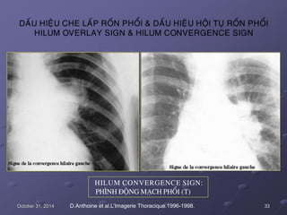 HILUM CONVERGENCE SIGN:
PHÌNH ÑOÄNG MAÏCH PHOÅI (T)
October 31, 2014 D.Anthoine et al.L’Imagerie Thoracique.1996-1998. 33
 