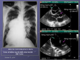 HILUM CONVERGENCE SIGN:
TAÊNG AÙP ÑOÄNG MAÏCH PHOÅI / ÑAÛO NGÖÔÏC
PHUÛ TAÏNG
October 31, 2014 34
 