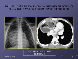 HILUM OVERLAY SIGN:
TERATOMA
October 31, 2014 35
 