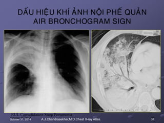 RUL Consolidation Strep Pneumonia
October 31, 2014 A.J.Chandrasekhar,M.D.Chest X-ray Atlas. 37
 