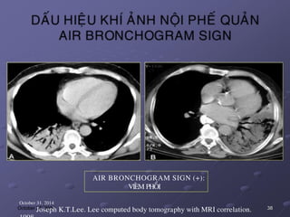 AIR BRONCHOGRAM SIGN (+):
VIEÂM PHOÅI
October 31, 2014
Joseph K.T.Lee. Lee computed body tomography with MRI correlation. 38
 
