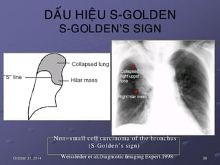 October 31, 2014
Non–small cell carcinoma of the bronchus
(S-Golden’s sign)
Weissleder et al.Diagnostic Imaging Expert.1998 39
 