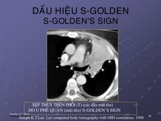 XEÏP THUØY TREÂN PHOÅI (T) (caùc ñaàu muõi teân)
DO U PHEÁ QUAÛN (muõi teân) S-GOLDEN’S SIGN
October 31, 2014
Joseph K.T.Lee. Lee computed body tomography with MRI correlation. 1998
40
 