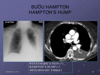 October 31, 2014
WESTEMARK’S SIGN (+)
HAMPTON’S HUMP (+)
PULMONARY EMBOLI 43
 
