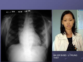 BN 25F.BVBD : U TRUNG
THẤT
 