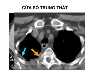 CỬA SỔ TRUNG THẤT
 