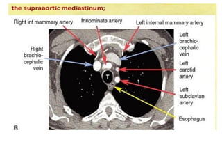 • Internalmammaryartery:ĐM vútrong
• Innominateartery:ĐM thâncánhtayđầu
• Brachiocephalic vein: TMthâncánhtayđầu
 