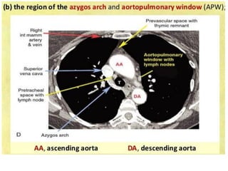 Azygosarch:quaiTM đơn,aorticpulmonarywindow:cửasổphếchủ,pretracheal:
trước khíquản
 
