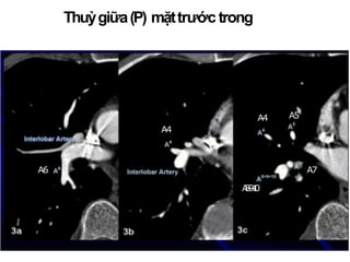 Thuỳgiữa(P) mặttrước trongcủaĐMgianthuỳ
A6
A4 A5
A4
A
8
-
‐
9
-
‐
1
0
A7
 