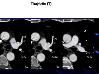 Thuỳtrên(T)
NhánhA1+2:từ mặttrênĐMphổi (T)đi lêntrên
NhánhA3:đi ratrước
A3
A1+
2 A1+
2
A3
A1+
2
 