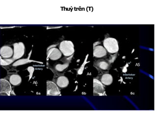 Thuỳtrên(T)
NhánhA4:lưỡi trên, từ mặttrước ĐM gianthuỳđi lên trên
A4
A5
A6
 