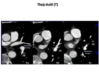 Thuỳdưới (T)
NhánhA6:từ ĐM gianthuỳngangmứchoặcngaytrênchỗ xuất
phátĐMthuỳlưỡi, đi rasau
A4
A5
A6
 