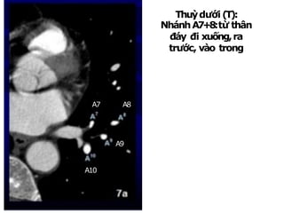 Thuỳdưới(T):
NhánhA7+8:từ thân
đáy đi xuống,ra
trước, vào trong
NhánhA9:rangoài
NhánhA10:rasau
A9
A10
A8
A7
 