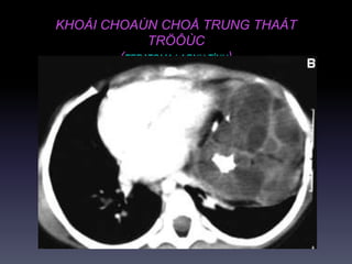 KHOÁI CHOAÙN CHOÅ TRUNG THAÁT
TRÖÔÙC
(TERATOMA LAØNH TÍNH)
 