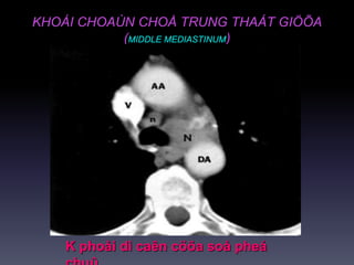 KHOÁI CHOAÙN CHOÅ TRUNG THAÁT GIÖÕA
(MIDDLE MEDIASTINUM)
K phoåi di caên cöõa soå pheá
 