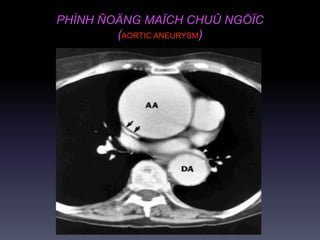 PHÌNH ÑOÄNG MAÏCH CHUÛ NGÖÏC
(AORTIC ANEURYSM)
 