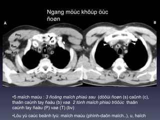 Ngang möùc khôùp öùc
ñoøn
•5 maïch maùu : 3 ñoäng maïch phiaù sau (döôùi ñoøn (s) caûnh (c),
thaân caùnh tay ñaàu (b) vaø 2 tónh maïch phiaù tröôùc thaân
caùnh tay ñaàu (P) vaø (T) (bv)
•Löu yù caùc beänh lyù: maïch maùu (phình-daõn maïch..), u, haïch
 