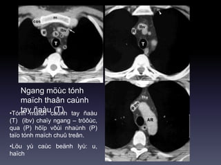Ngang möùc tónh
maïch thaân caùnh
tay ñaàu (T)•Tónh maïch caùnh tay ñaàu
(T) (ibv) chaïy ngang – tröôùc,
qua (P) hôïp vôùi nhaùnh (P)
taïo tónh maïch chuû treân.
•Löu yù caùc beänh lyù: u,
haïch
 