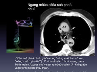 Ngang möùc cöõa soå pheá
chuû
•Cöõa soå pheá chuû: giöõa cung ñoäng maïch chuû vaø
ñoäng maïch phoåi (T) . Coù vaøi haïch nhoû vuøng naøy.
Tónh maïch Azygos chaïy sau, ra tröôùc caïnh (P) khí quaûn
vaøo tónh maïch chuû treân.
Av
 