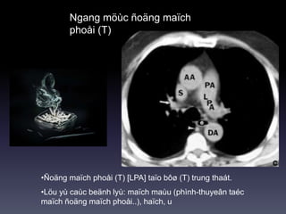 Ngang möùc ñoäng maïch
phoåi (T)
•Ñoäng maïch phoåi (T) [LPA] taïo bôø (T) trung thaát.
•Löu yù caùc beänh lyù: maïch maùu (phình-thuyeân taéc
maïch ñoäng maïch phoåi..), haïch, u
 