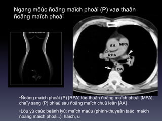 Ngang möùc ñoäng maïch phoåi (P) vaø thaân
ñoäng maïch phoåi
•Ñoäng maïch phoåi (P) [RPA] töø thaân ñoäng maïch phoåi [MPA],
chaïy sang (P) phiaù sau ñoäng maïch chuû leân [AA]
•Löu yù caùc beänh lyù: maïch maùu (phình-thuyeân taéc maïch
ñoäng maïch phoåi..), haïch, u
 