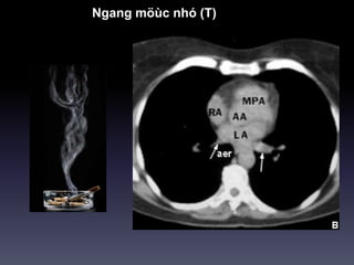 Ngang möùc nhó (T)
 