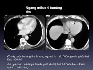 Ngang möùc 4 buoàng
tim
•Thaáy caùc buoàng tim. Maøng ngoaøi tim taïo ñöôøng môø giöõa hai
lôùp môõ [M]
•Löu yù caùc beänh lyù: tim (huyeát khoái), haïch tröôùc tim, u thöïc
quaûn, coät soáng
M
 