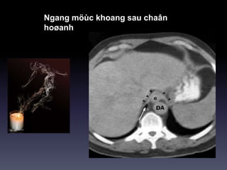 Ngang möùc khoang sau chaân
hoøanh
 