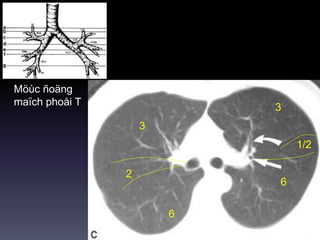 Möùc ñoäng
maïch phoåi T
3
3
6
6
1/2
2
 