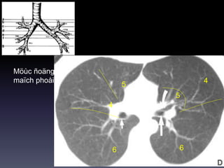 Möùc ñoäng
maïch phoåi P
66
5
4
5
4
 