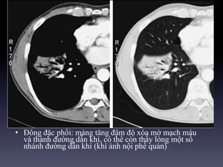 • Đông đặc phổi: mảng tăng đậm độ xóa mờ mạch máu
và thành đường dẫn khí, có thể còn thấy lòng một số
nhánh đường dẫn khí (khí ảnh nội phế quản)
 