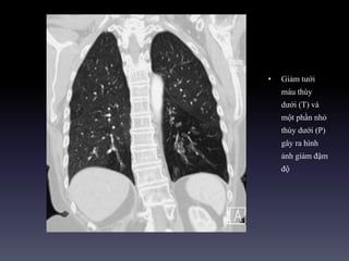 • Giảm tưới
máu thùy
dưới (T) và
một phần nhỏ
thùy dưới (P)
gây ra hình
ảnh giảm đậm
độ
 