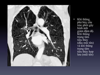 • Khí thũng
phá hủy cấu
trúc phổi gây
hình ảnh
giảm đậm độ.
Khí thũng
trung tâm
tiểu thùy
(đầu mũi tên)
và khí thũng
trung tâm
tiểu thùy hợp
lưu (mũi tên)
 