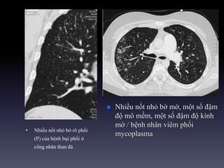 • Nhiều nốt nhỏ bờ rõ phổi
(P) của bệnh bụi phổi ở
công nhân than đá
 Nhiều nốt nhỏ bờ mờ, một số đậm
độ mô mềm, một số đậm độ kính
mờ / bệnh nhân viêm phổi
mycoplasma
 