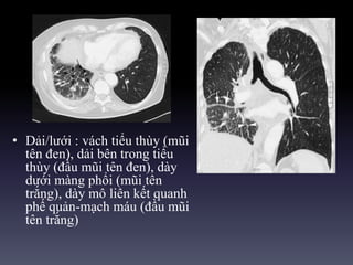 • Dải/lưới : vách tiểu thùy (mũi
tên đen), dải bên trong tiểu
thùy (đầu mũi tên đen), dày
dưới màng phổi (mũi tên
trắng), dày mô liên kết quanh
phế quản-mạch máu (đầu mũi
tên trắng)
 