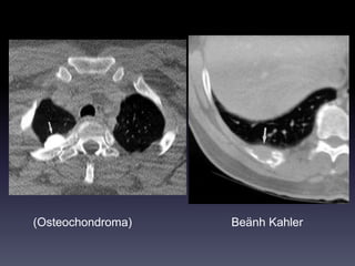 (Osteochondroma) Beänh Kahler
 