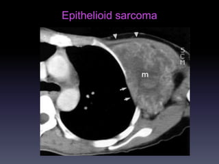 Epithelioid sarcoma
 