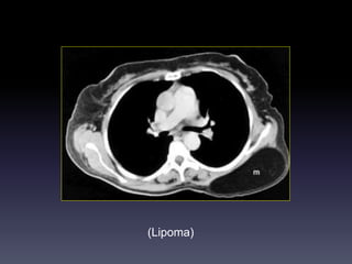 (Lipoma)
 