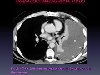 TRAØN DÒCH MAØNG PHOÅI TÖÏ DO
Dòch töï do khoang maøng phoåi, gaây xeïp phoåi
thuï ñoïng
 