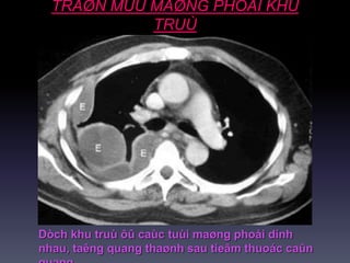 TRAØN MUÛ MAØNG PHOÅI KHU
TRUÙ
Dòch khu truù ôû caùc tuùi maøng phoåi dính
nhau, taêng quang thaønh sau tieâm thuoác caûn
 